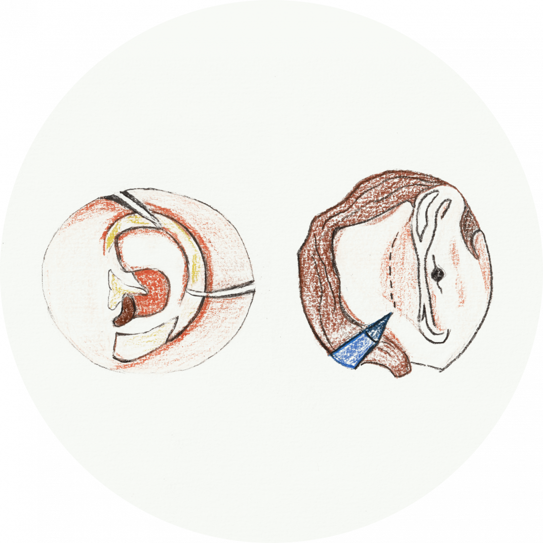 Procedure details: Ear Reshaping