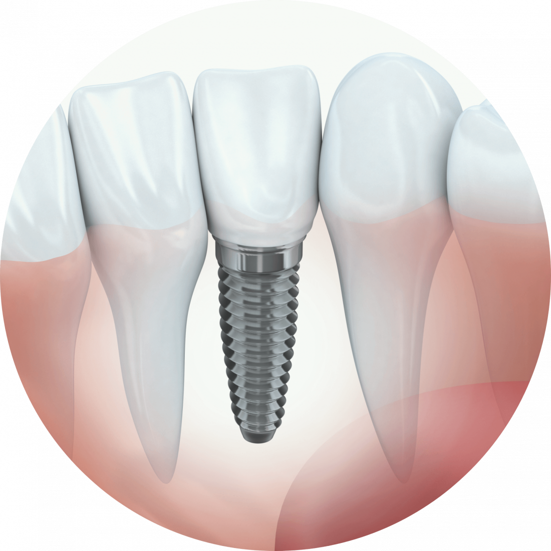 Procedure details: Implants treatment