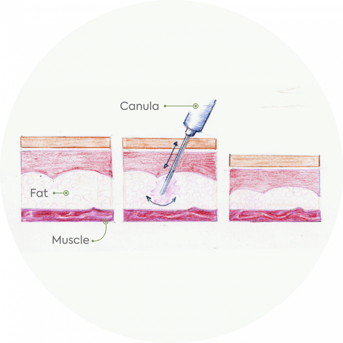 Procedure details: Gynecomastia